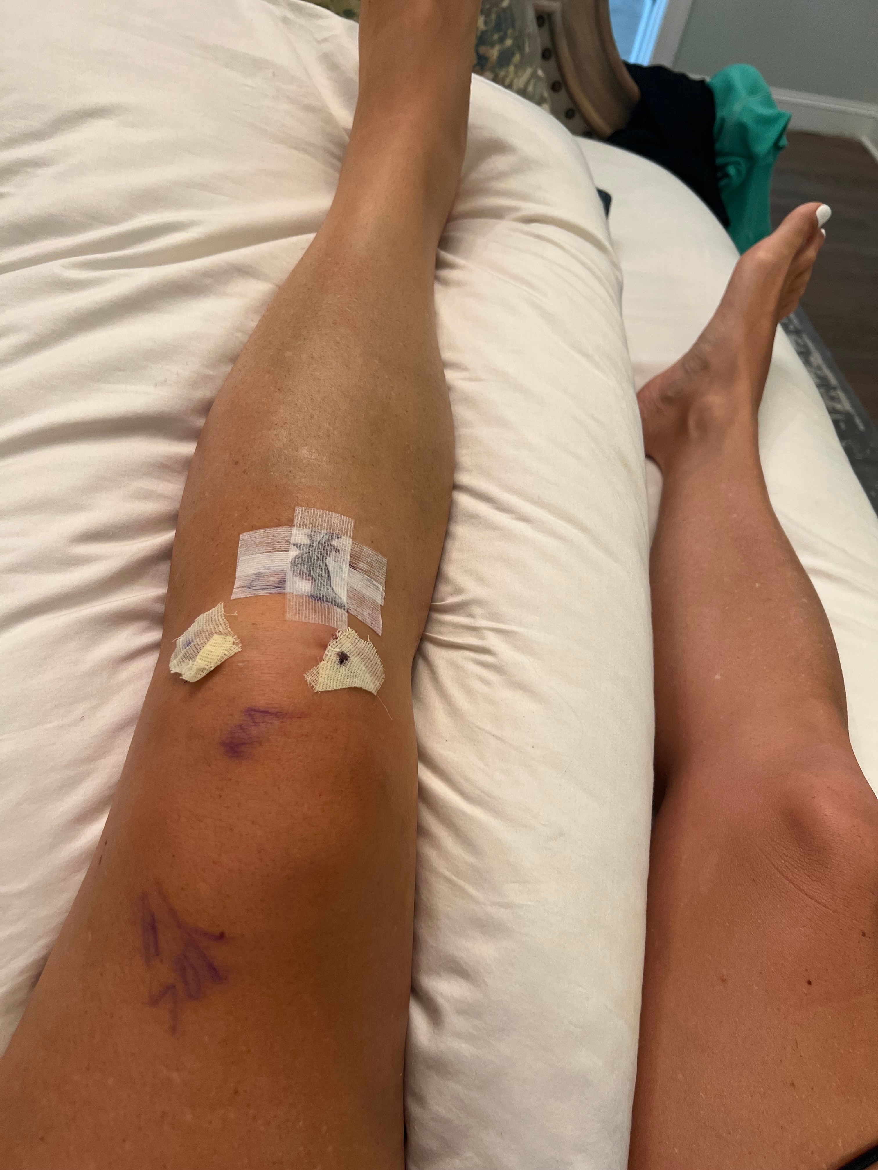 Kim's left knee after ACL surgery