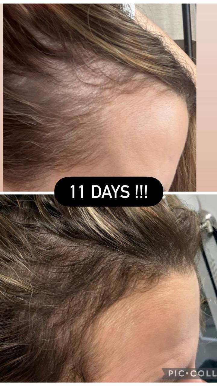 Client hair growth, 11 days